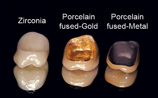 Dental-crown